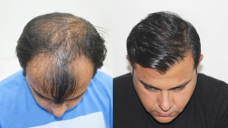hair-restoration-results-rajasthan-768x432-1.jpeg