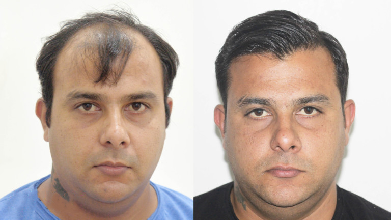 hair-transplant-indore-768x432-1.jpeg